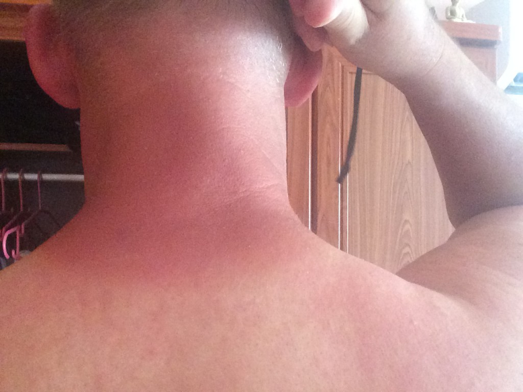 Sunburn in neck after 1 day
