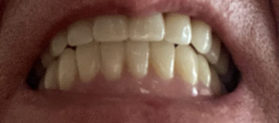 New dentures