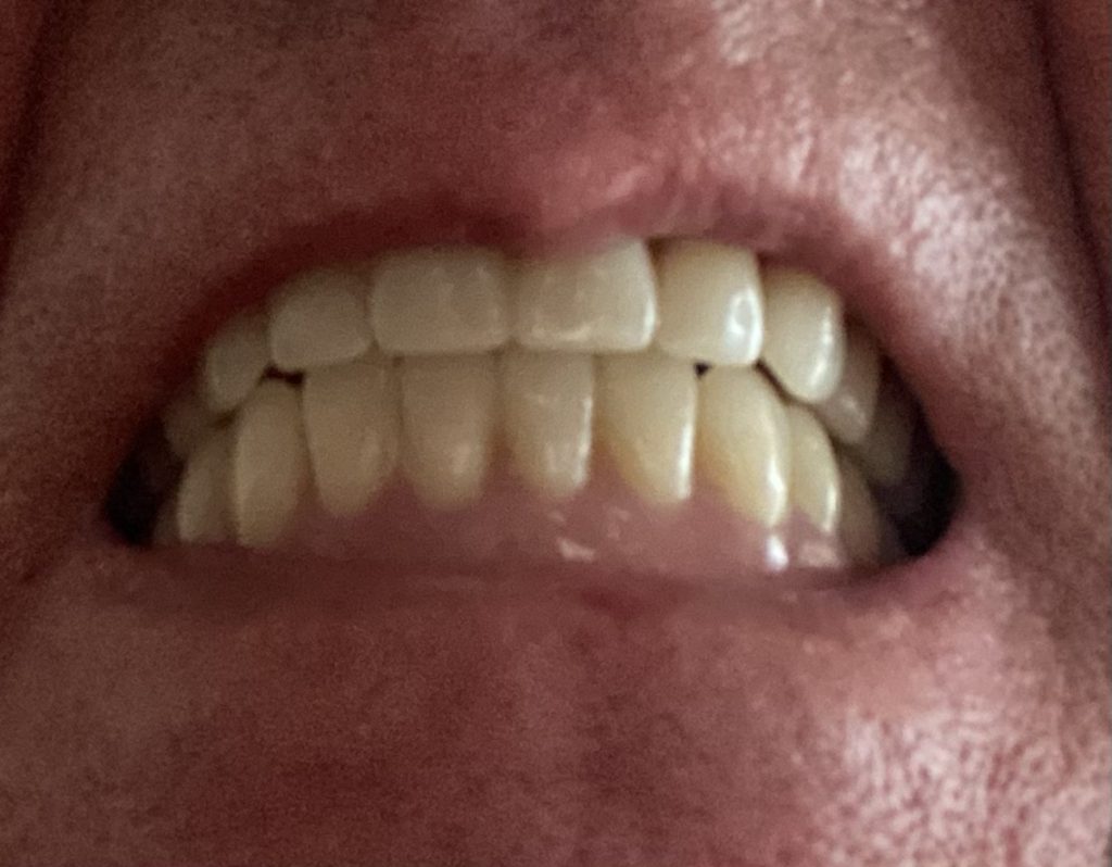 New dentures